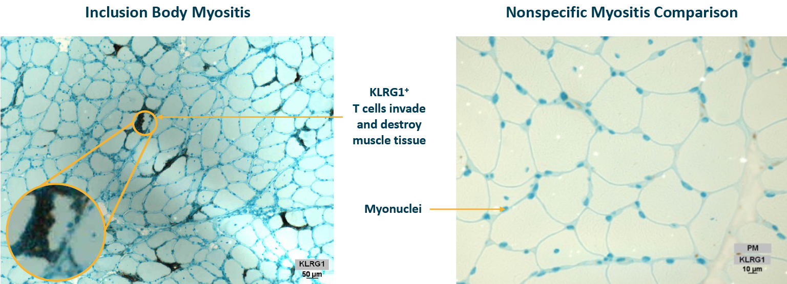 Image of T cell infiltration into muscle